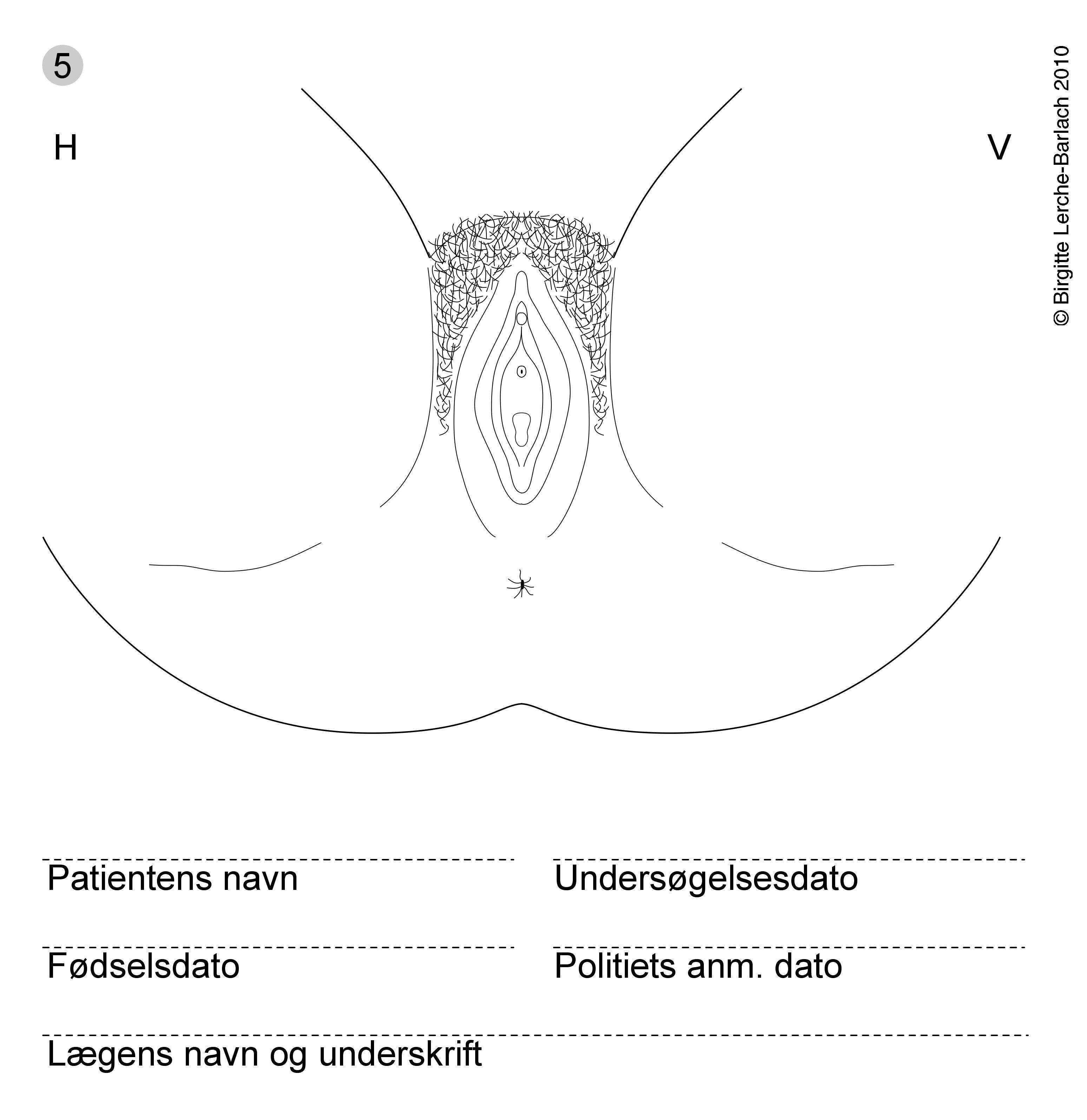 kvindelige genitalia-voldtaegt skitse