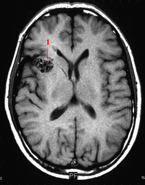 AV-malformation-angio-mr