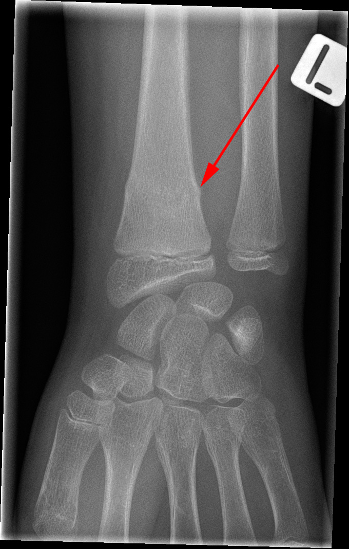 haand-green stick fraktur-roentgen