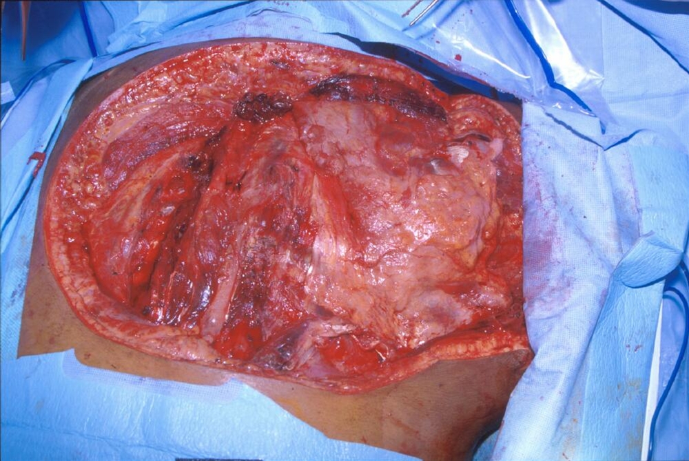 gassgangren-aabent saar-infektioner