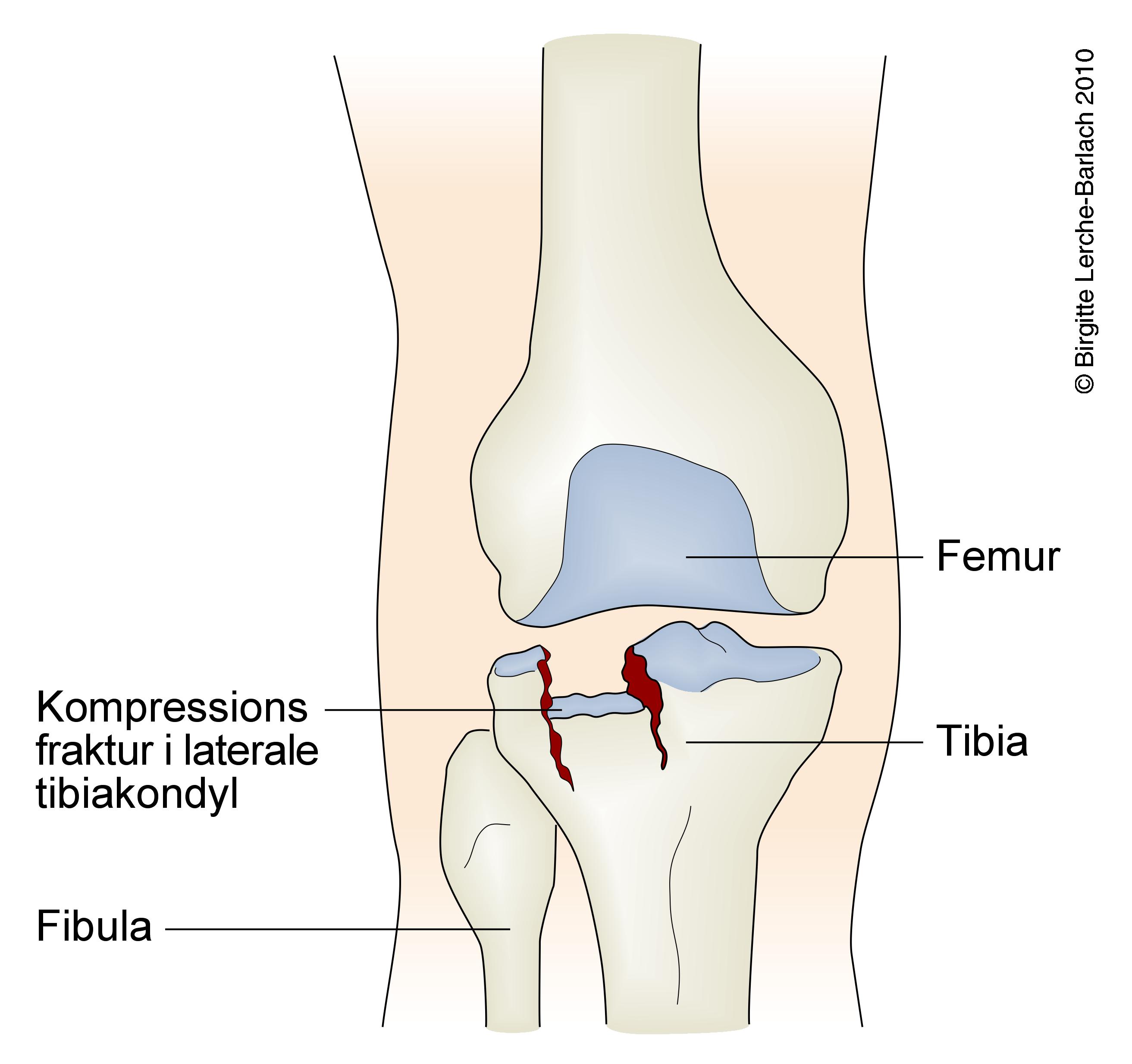 skinneben-kompressionsfraktur