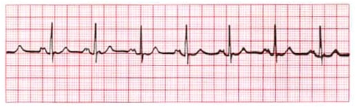 ekg-brede p