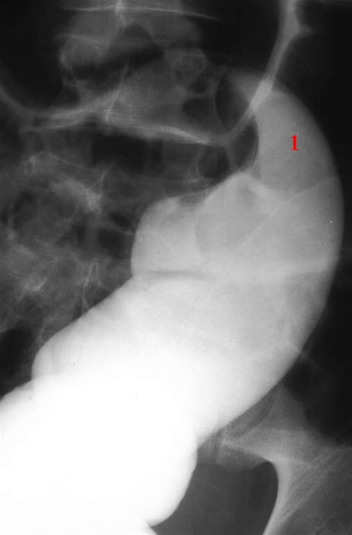 tyktarm-volvulus-roentgen