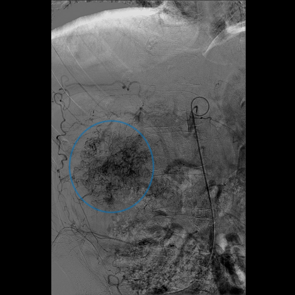 nyretumor tumorkar-arteriografi