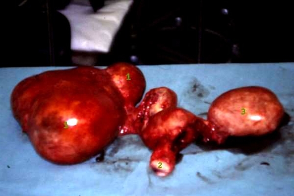 bilaterale dermoider