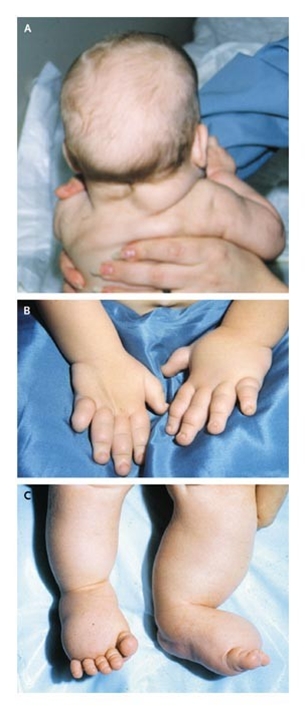 nyfoedt-turners syndrom