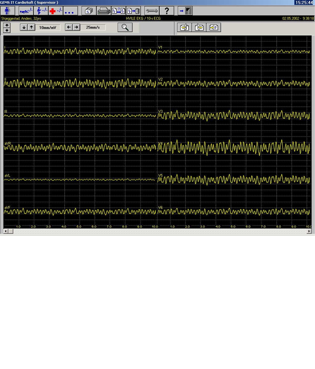 hjerte-ventrikelflimren-ekg