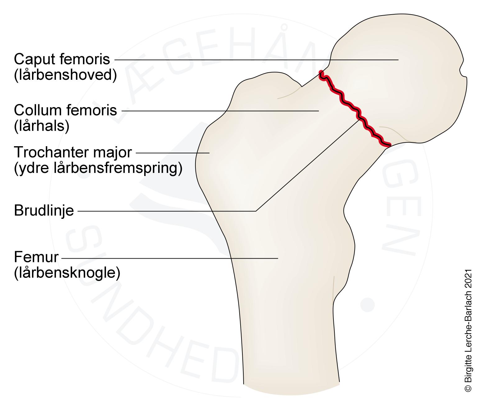 laarhals-fraktur collum femoris udisloceret