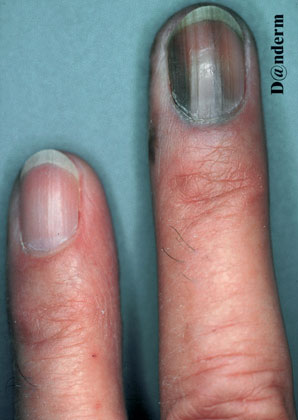 Malignant melanoma - acral lentiginous