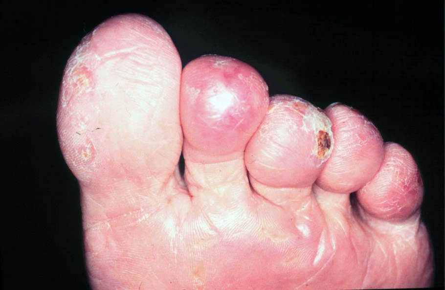 taeer-hudforandringer paa taeer ved pv