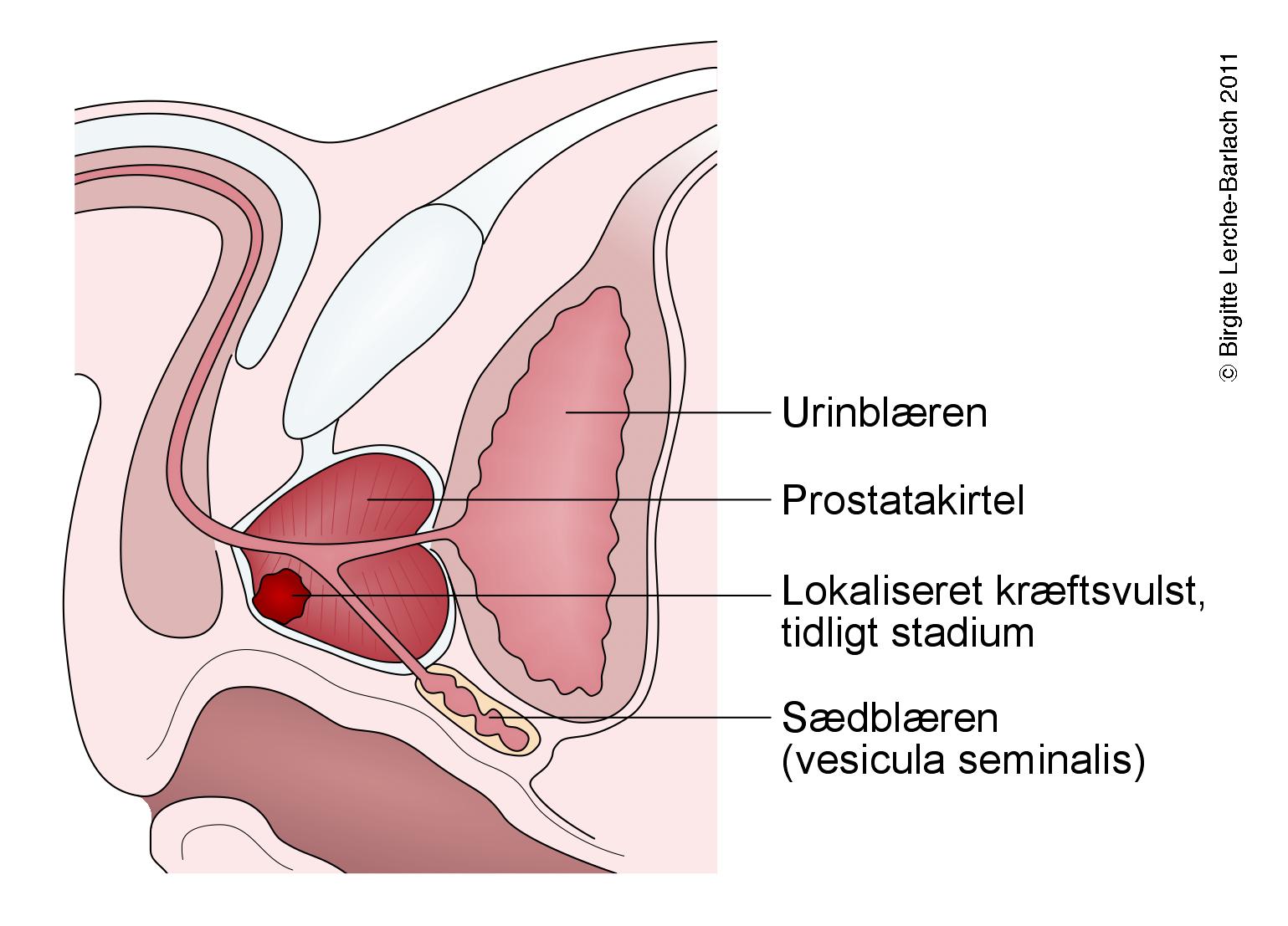 prostata-prostatacancer