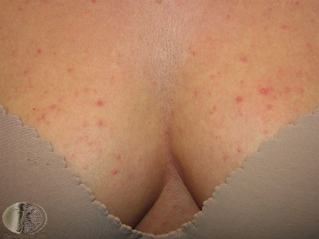 malasseziafollikulitis bryst