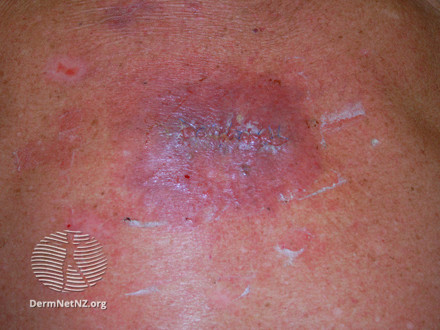 Foto af sår med infektion efter operation
