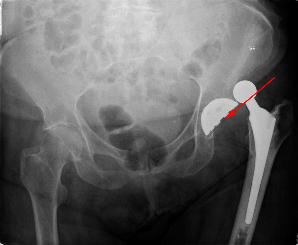 hofte-protese ude af led-roentgen