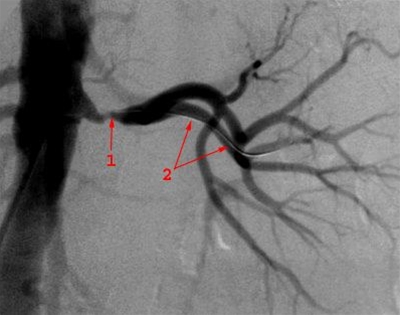 nyrearteriestenose-arteriografi