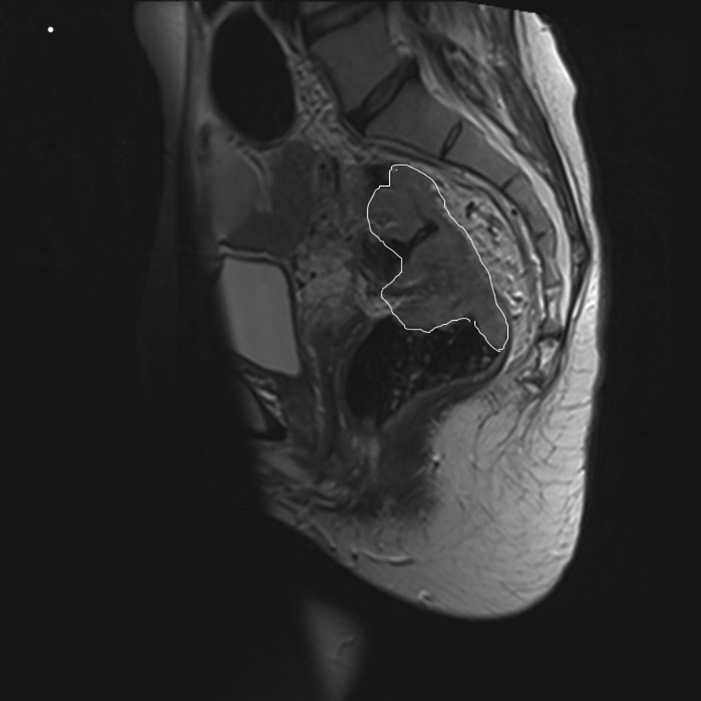colon-colorektal cancer laengdesnit-ct