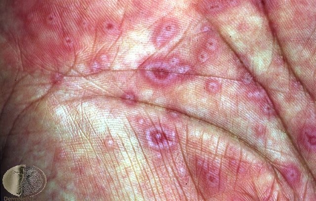 erythema multiforme haandflate jpg