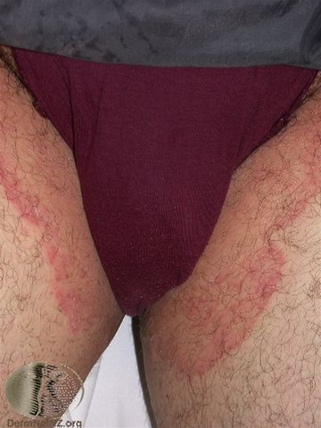 tinea cruris-lyske