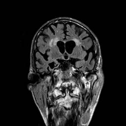 hjerne-aldersforandringer ud for ventriklerne-ct