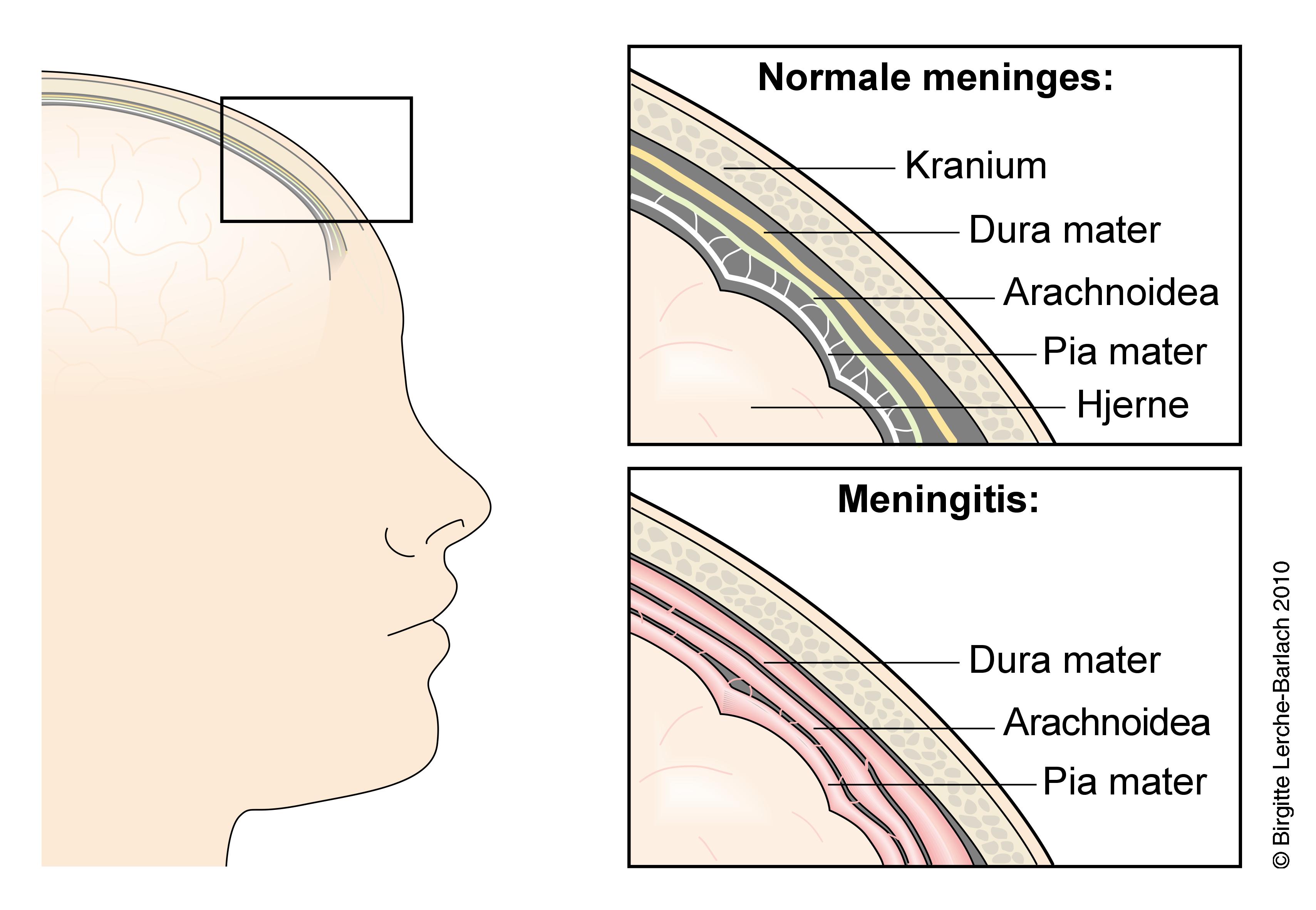 hoved-meningitis anatomi-2