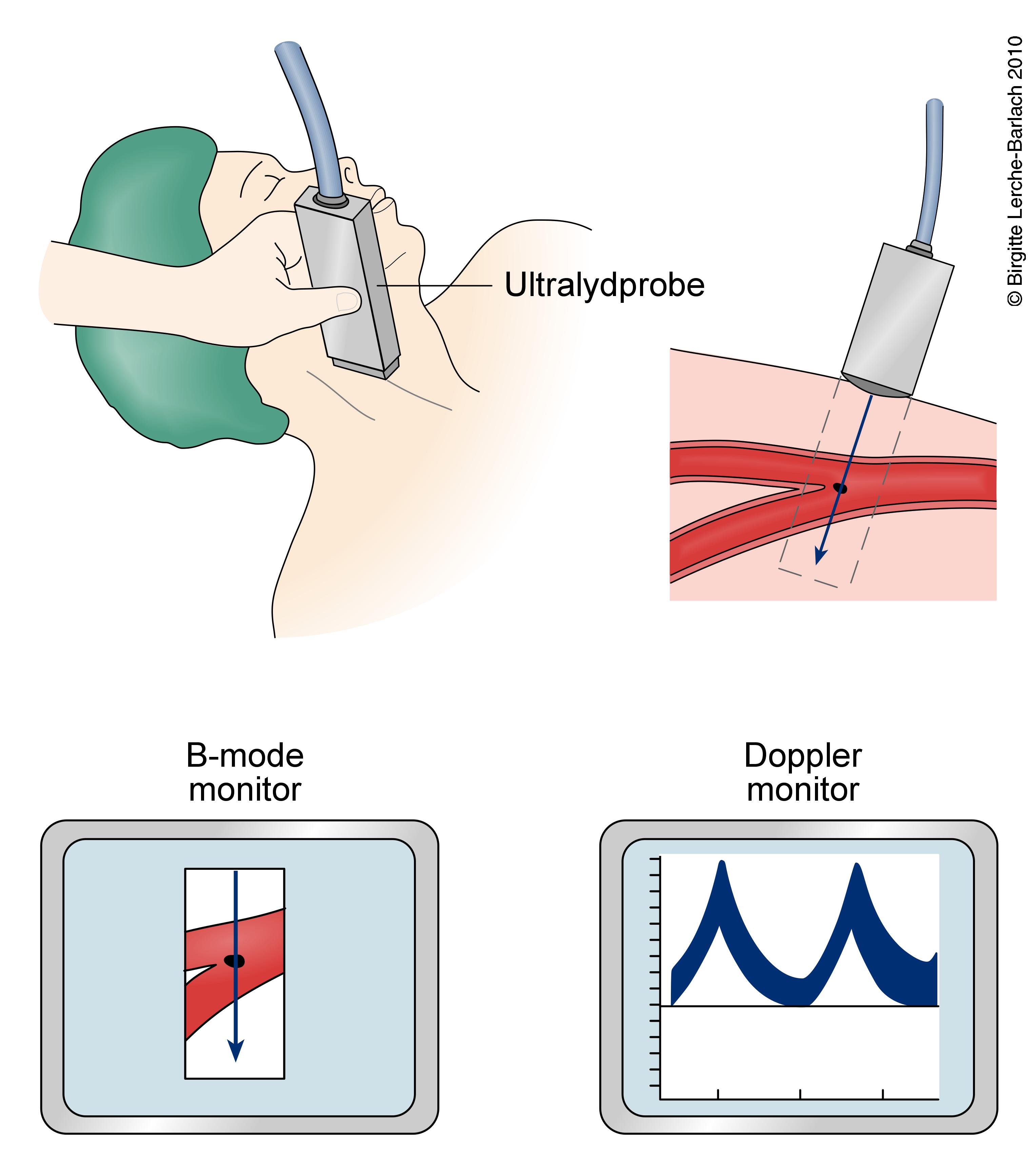 arteria carotis-ultralydscanning