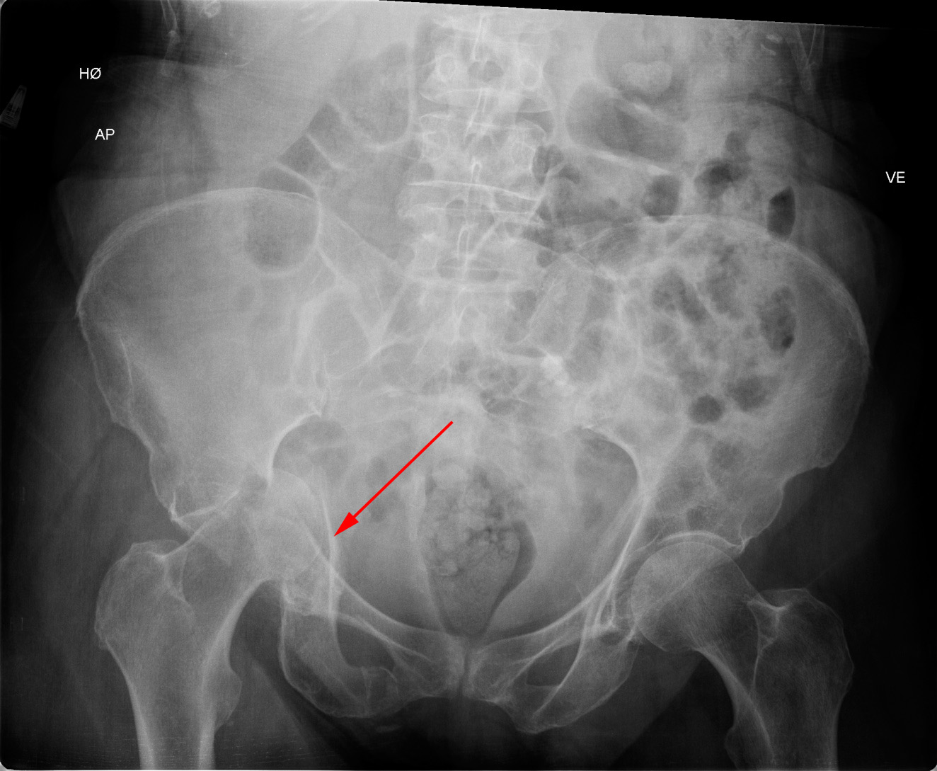 hofte-acebulatumfraktur-roentgen
