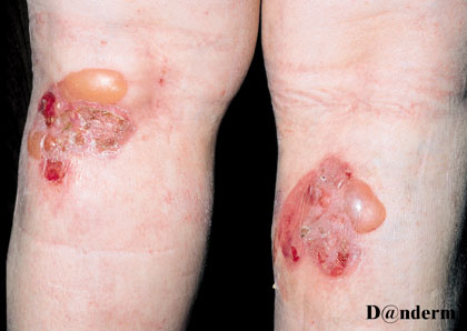 Bullous pemphigoid