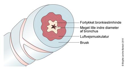 bronkier-bronkie ved astma