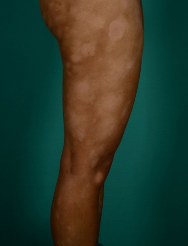 Foto af mycosis fungoides i patch-stadie på lår