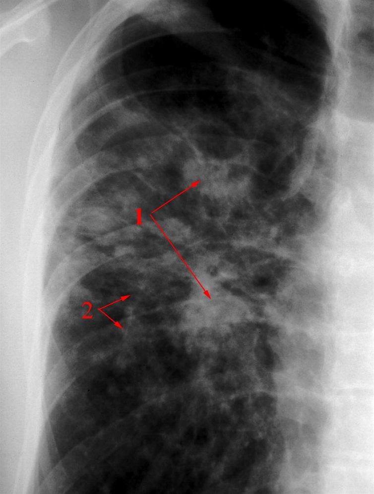lunger-sarkoidose-rtg