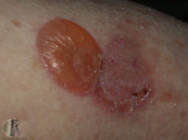 pemfigoid naerbillede