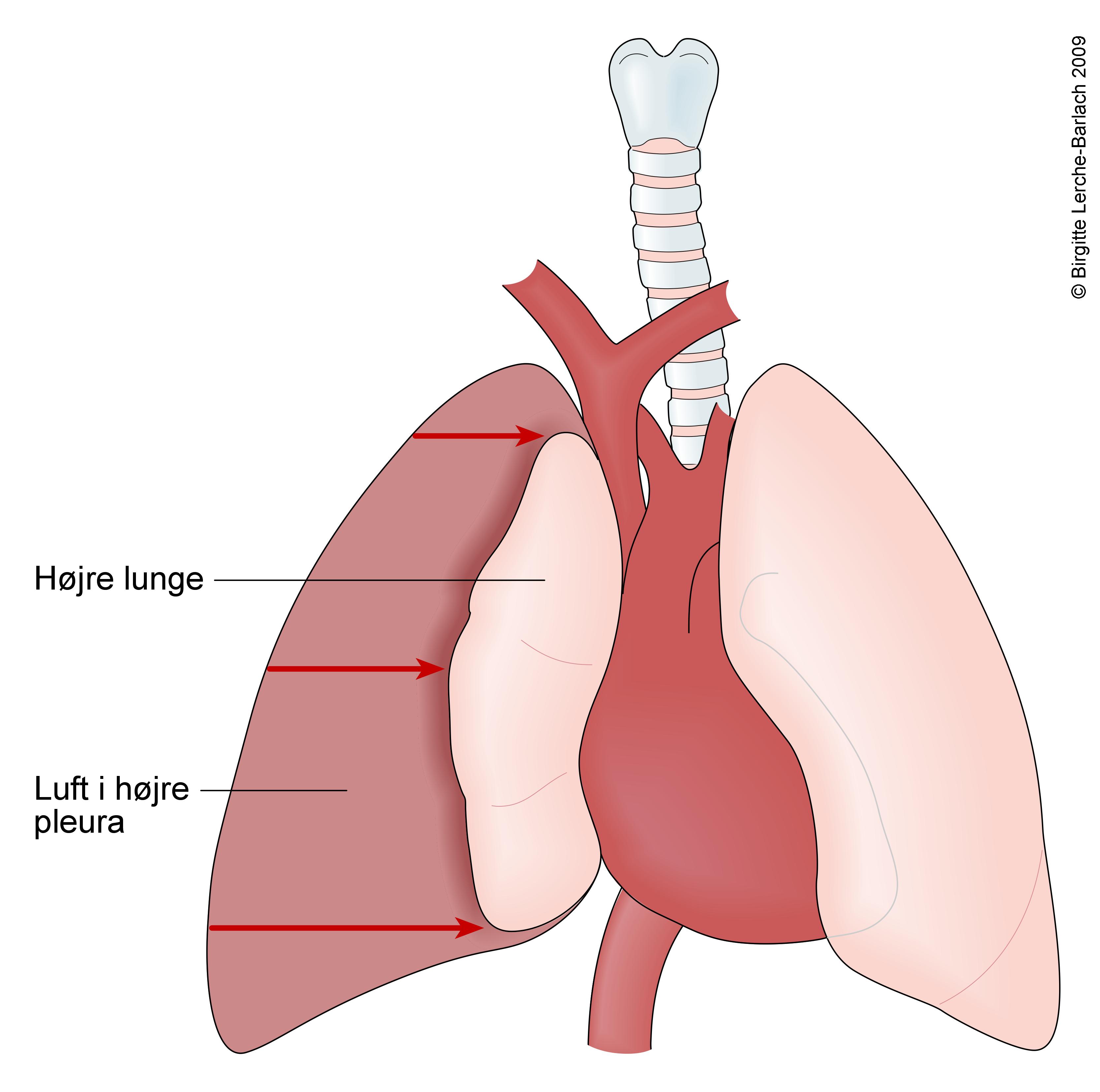 lunge-trykpneumothorax