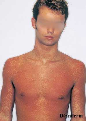 Medikamentelle eksantemer