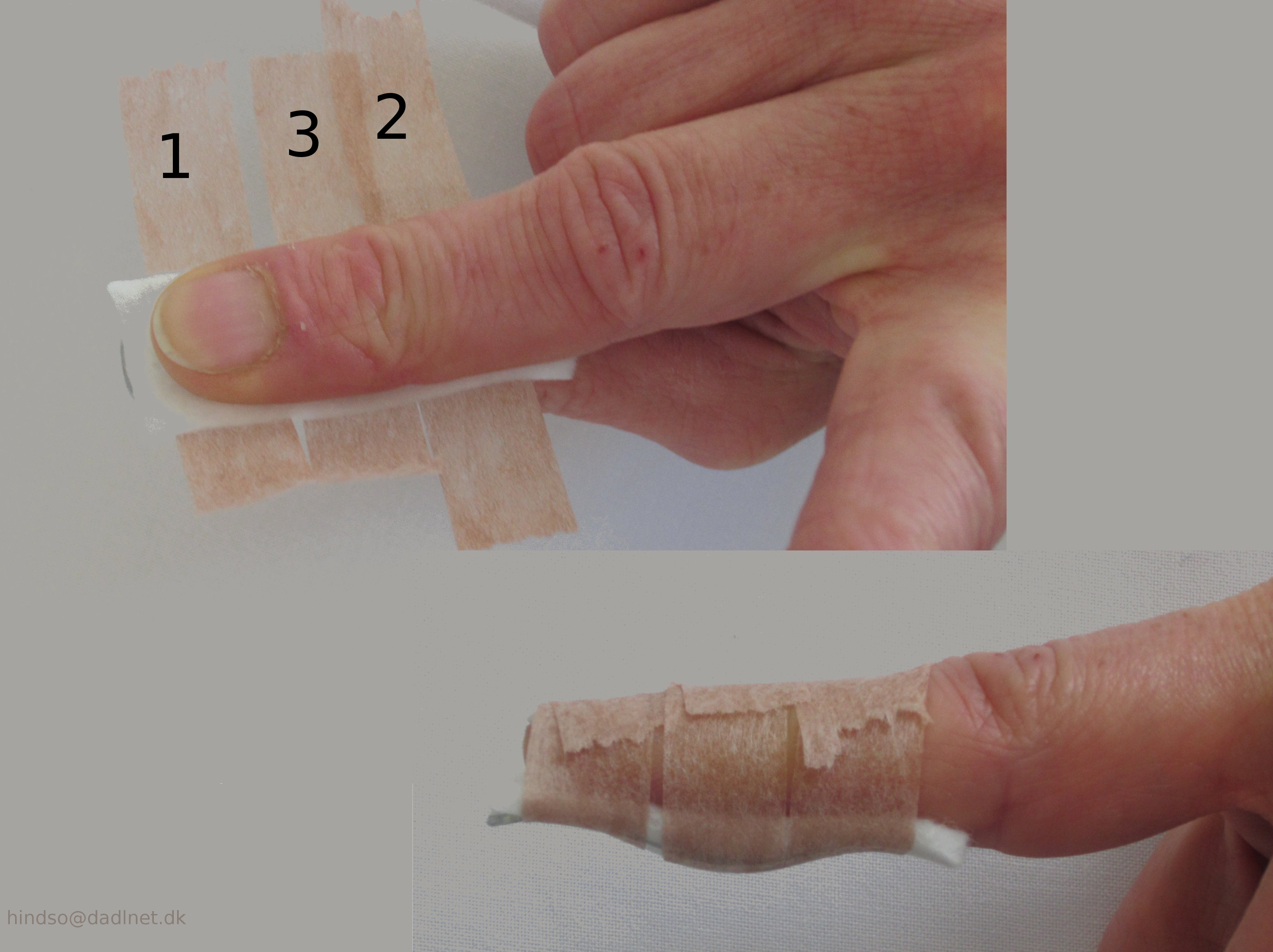 fingre- anlaeggelse af Carstamskinne