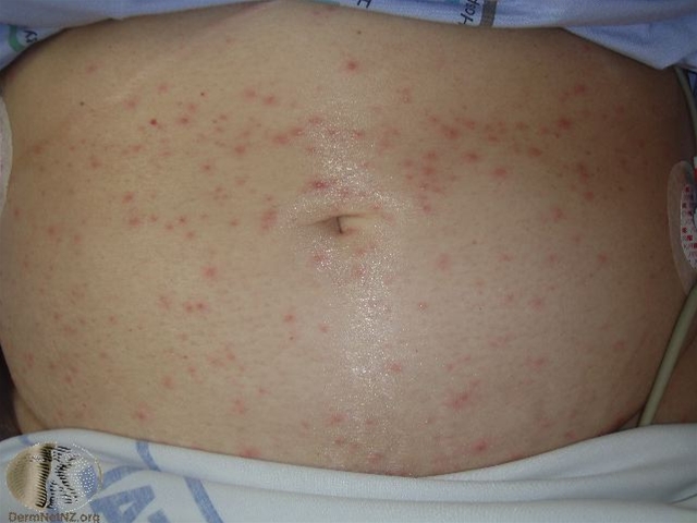 skoldkopper-tidlig-fase-1