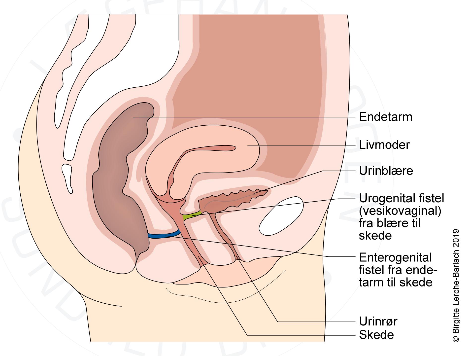 gynaekologiske-fistler