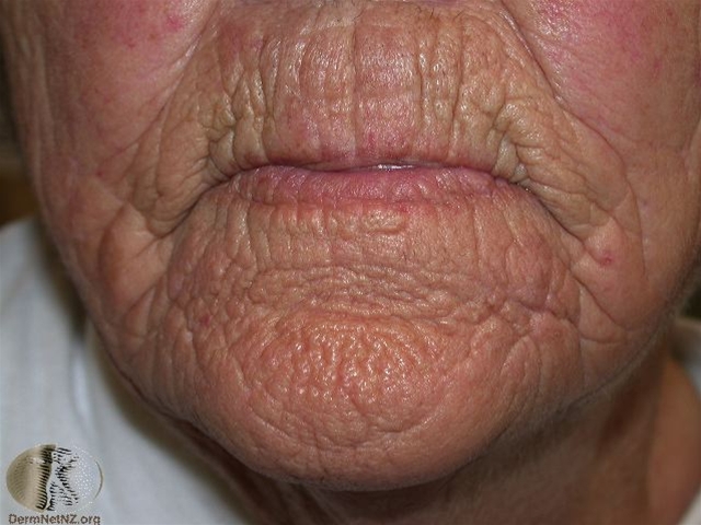 rynker-udtalt elastose-ansigt