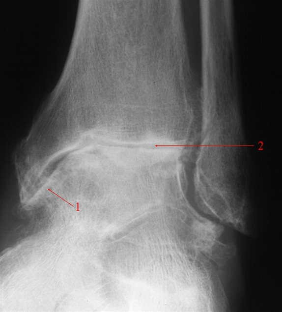 ankel-artrose skraa front-roentgen