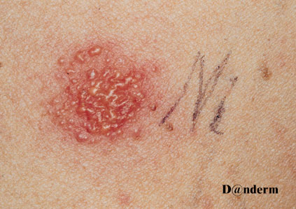 A positive nickel patch test