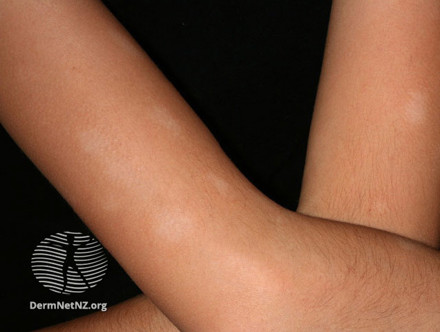Pityriasis alba på arme