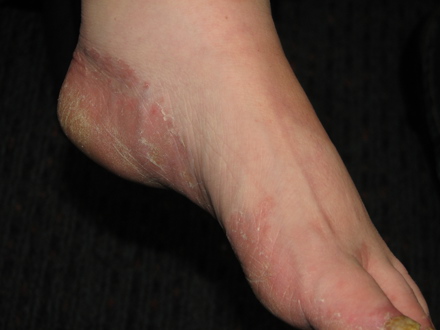 tinea pedis-fod