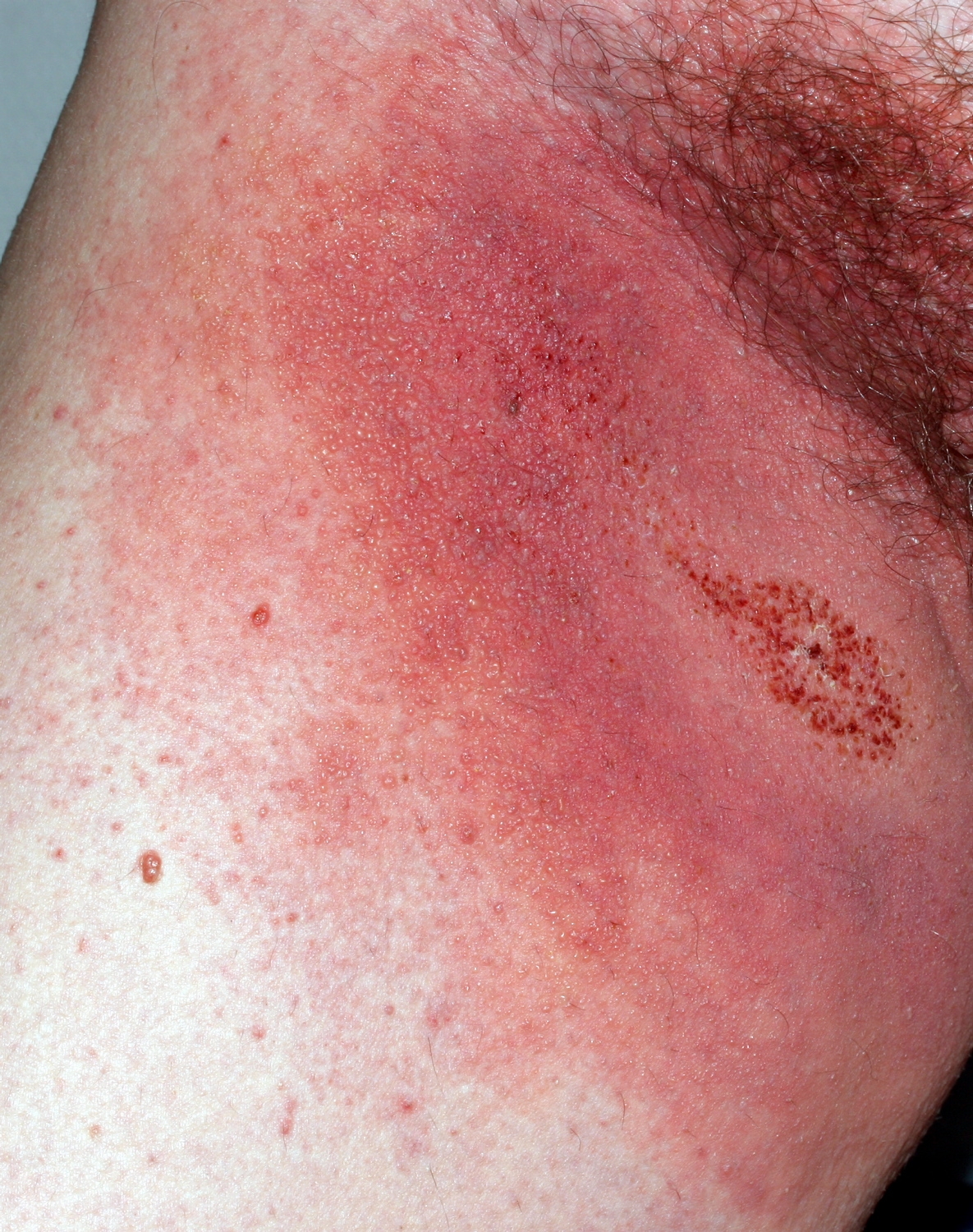 cellulitis