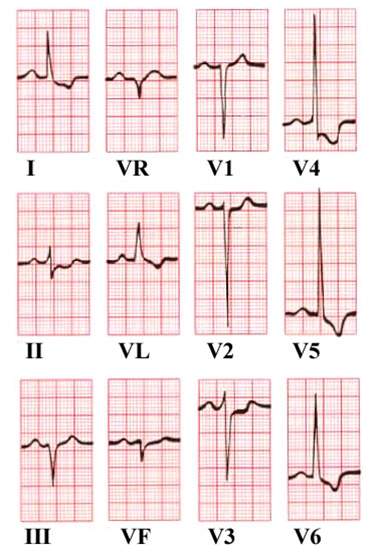 hjerte-venstre ventrikelhypertrofi-ekg