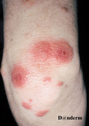 Erythema mulitiforme knae