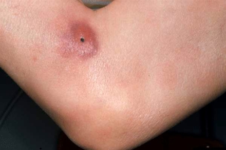 mycosis fungoides-arm