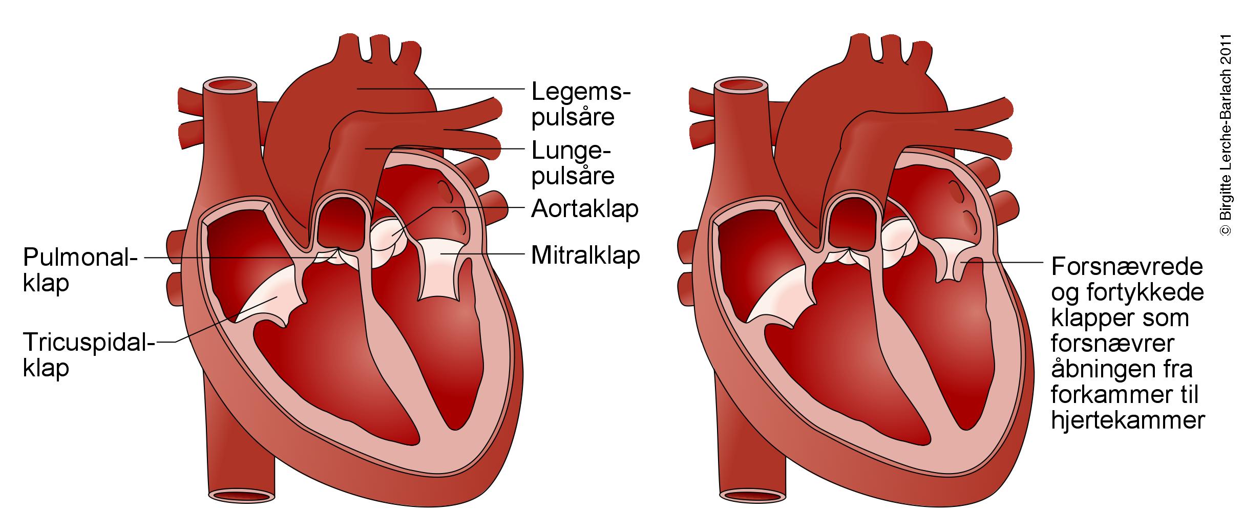 hjerte-mitralstenose