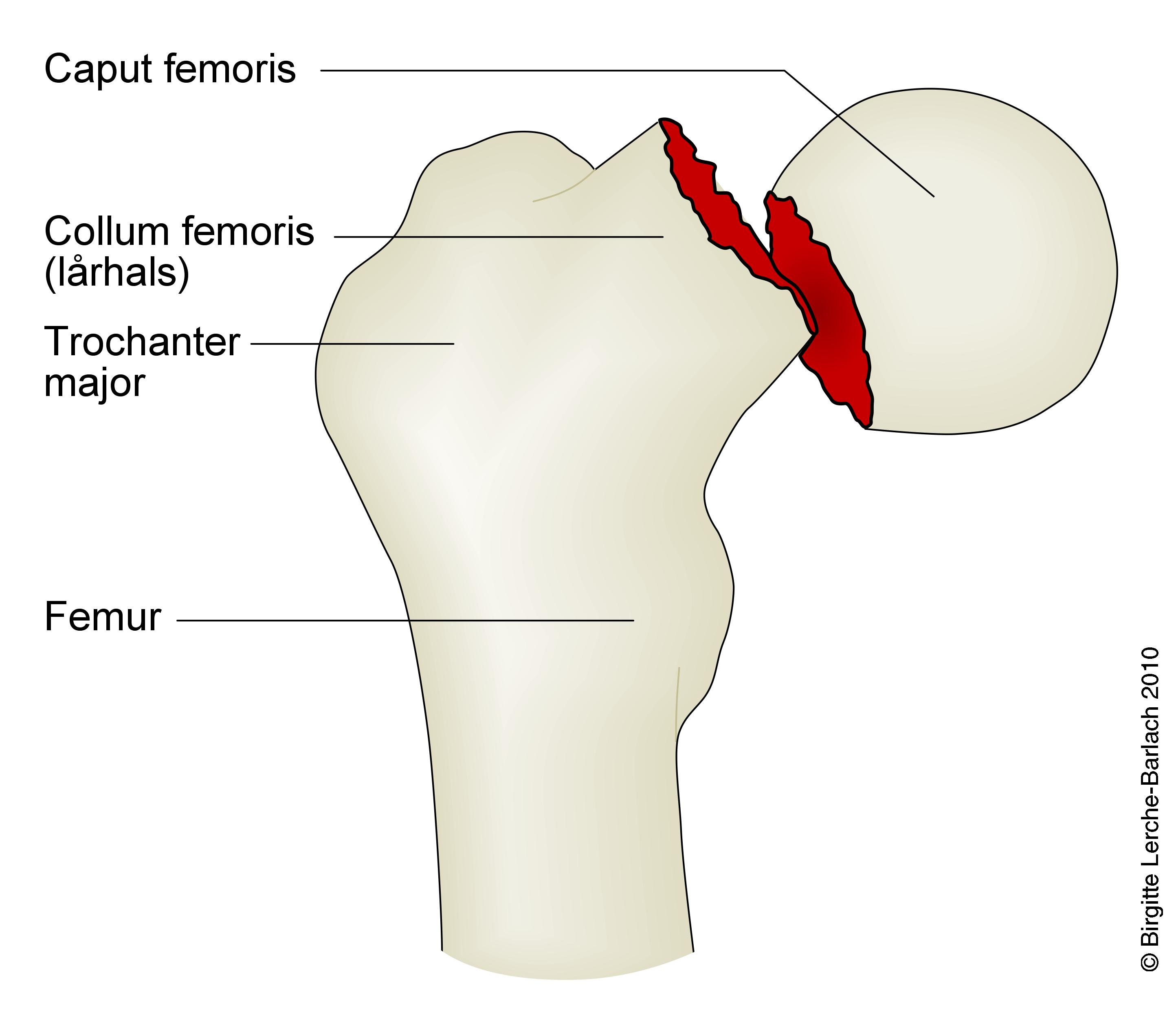 laarhals-fraktur collum femoris disloceret
