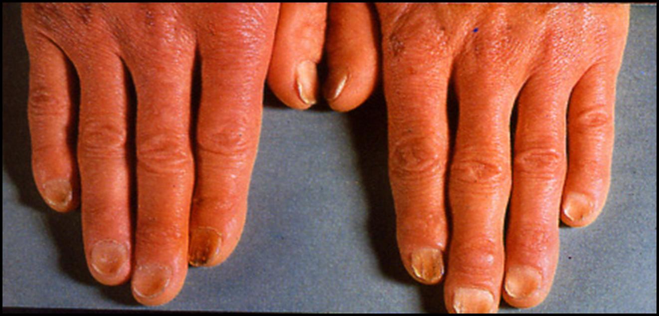 blod-skenegle hos patient med svaer jernmangel