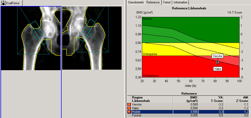 Hofter-DXA-skanning-normal
