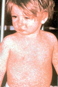 krop-maeslingeudslaet